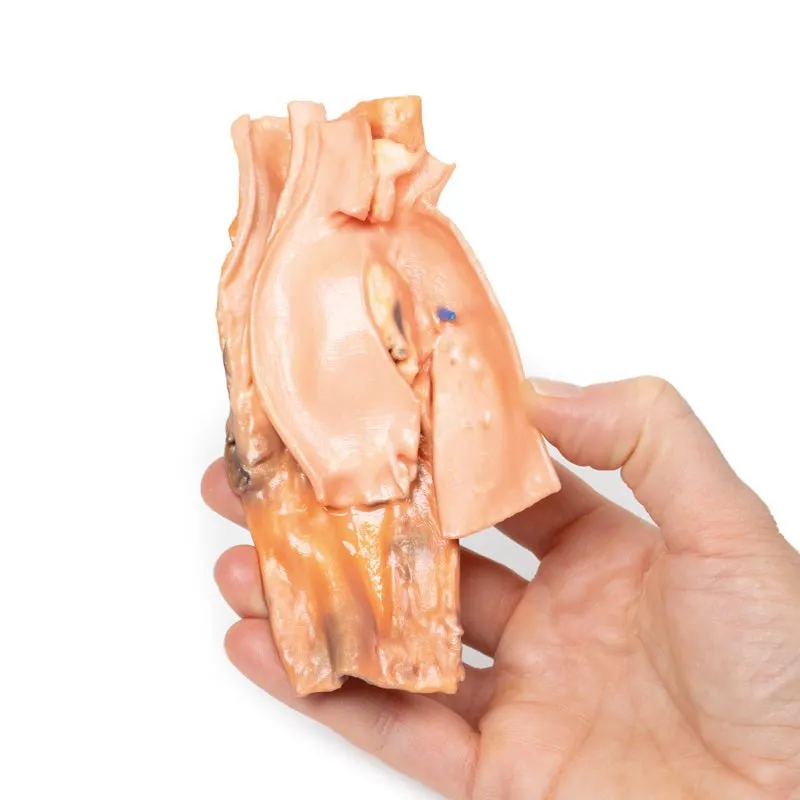 3D Printed Traumatic Oesophageal-aortic Fistula